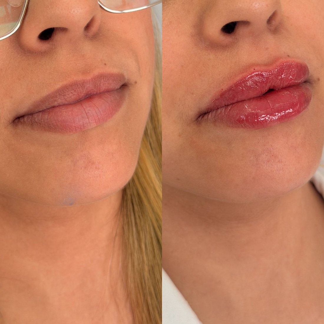 Antes e depois de preenchimento labial