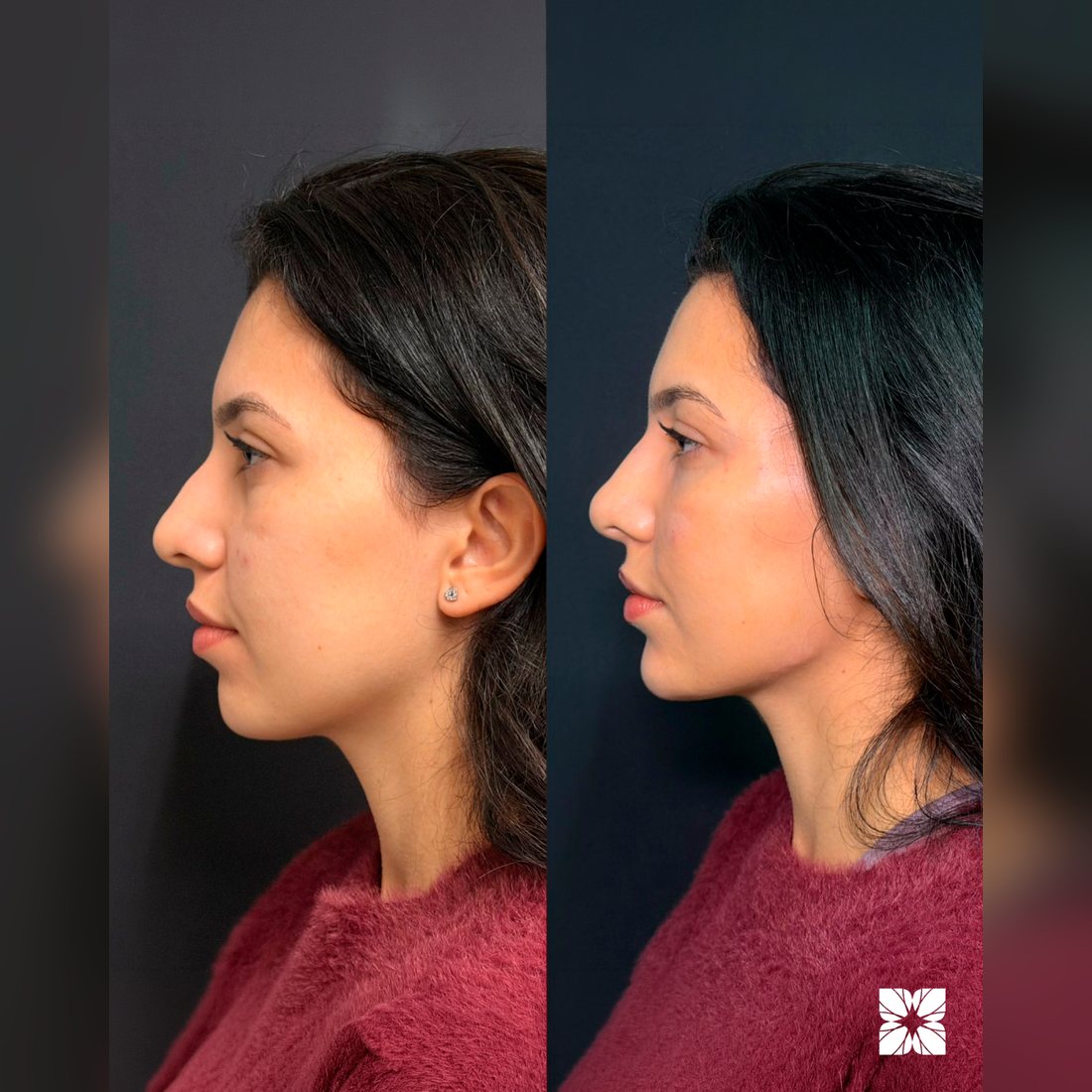 Antes e depois de rinomodelação
